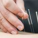 Akupunktura a riziko infekční nákazy