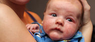 Děti nakažené žloutenkou typu B během porodu mají vyšší riziko vzniku atopie