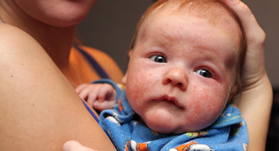 Děti nakažené žloutenkou typu B během porodu mají vyšší riziko vzniku atopie