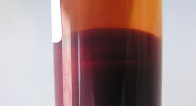  Oxidativní stres a steatóza jater v progresi chronické hepatitidy typu C
