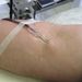 Krevní transfuze představuje jen minimální riziko přenosu žloutenky
