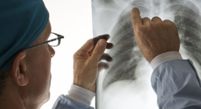 Intersticiální pneumonie spojená s interferonovou terapií u hepatitidy C